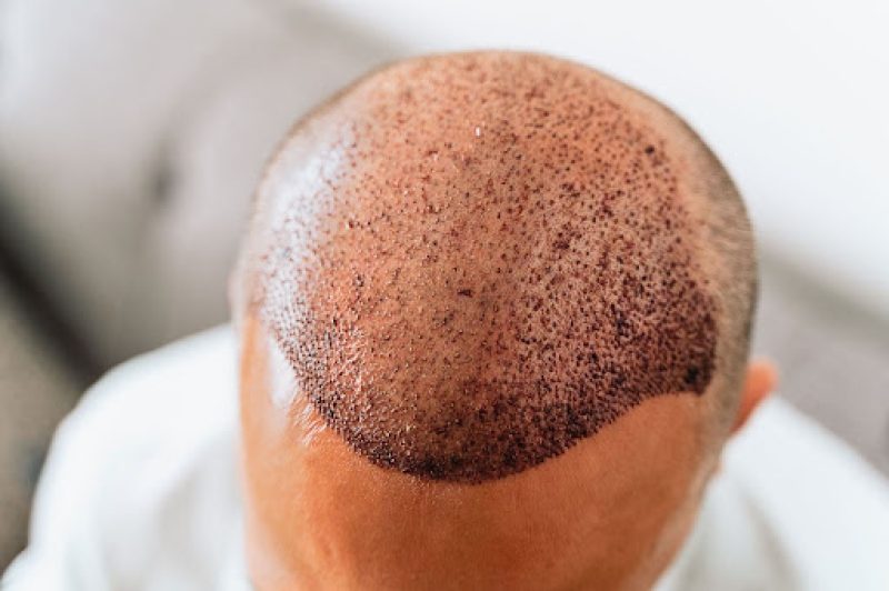 1735626735-1733766717-Hair_Transplant